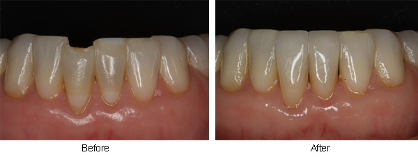 Before and after chipper lower incisor photos