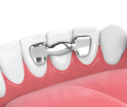 A Maryland Bridge with metal wings bonded to the backs of adjacent teeth
