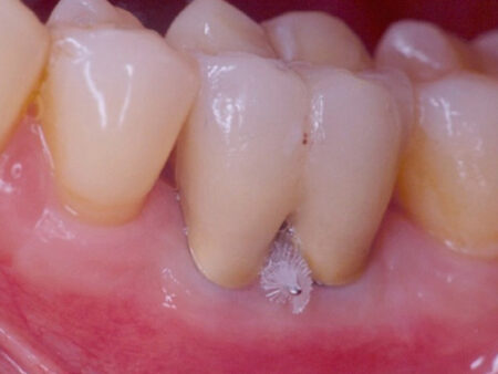 A molar tooth with a furcation involvement