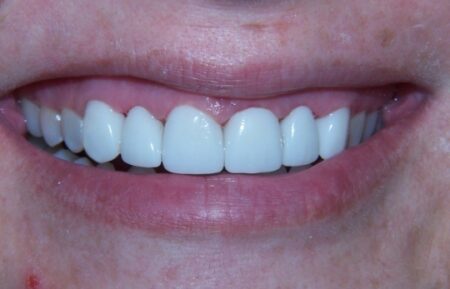 Dental crowns on six front teeth