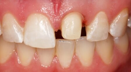 A front tooth prepared for a dental crown